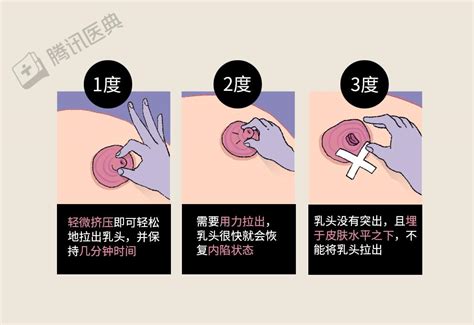 奶頭毛|你有「乳頭毛」嗎？女性「乳暈毛毛的」可能是嚴重疾病的症狀！。